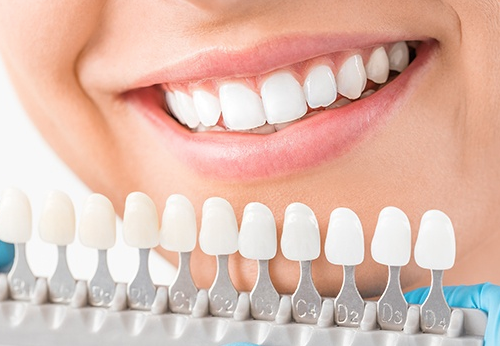 Veneers