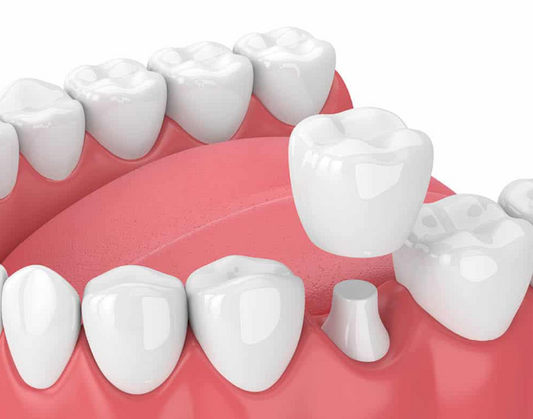 Dental Crown