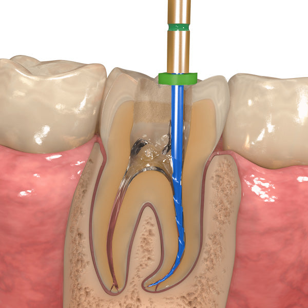 Endodontic Therapy