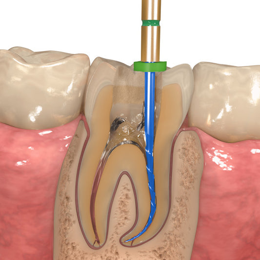 Endodontic Therapy