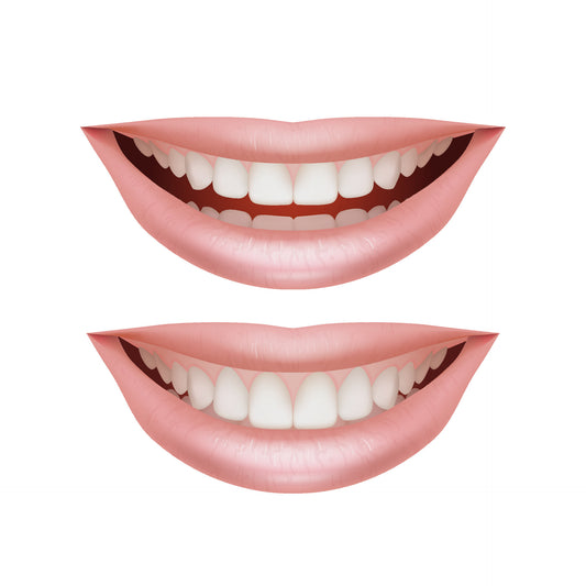 Full Arch Mouth Rehabilitation