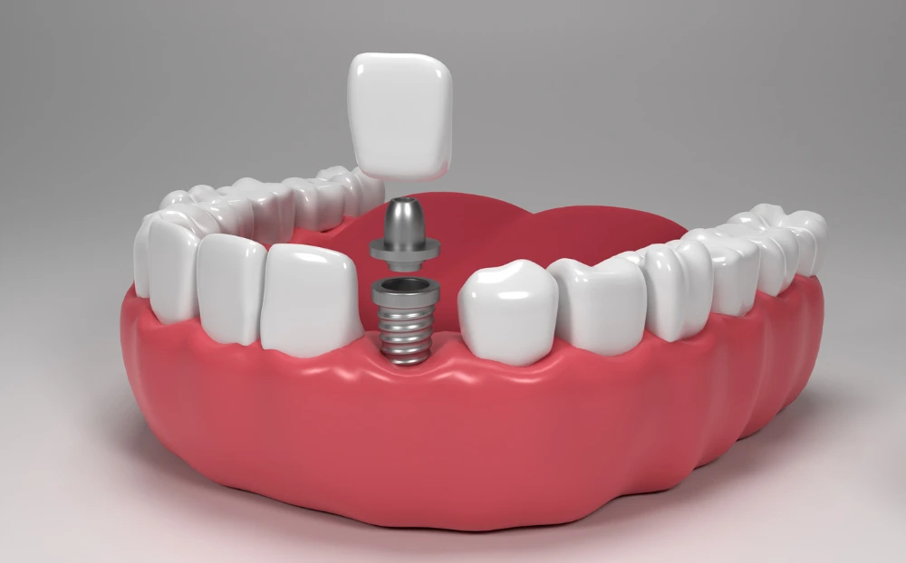 https://meditouring.com/wp-content/uploads/2025/11/Dental-Implant.webp