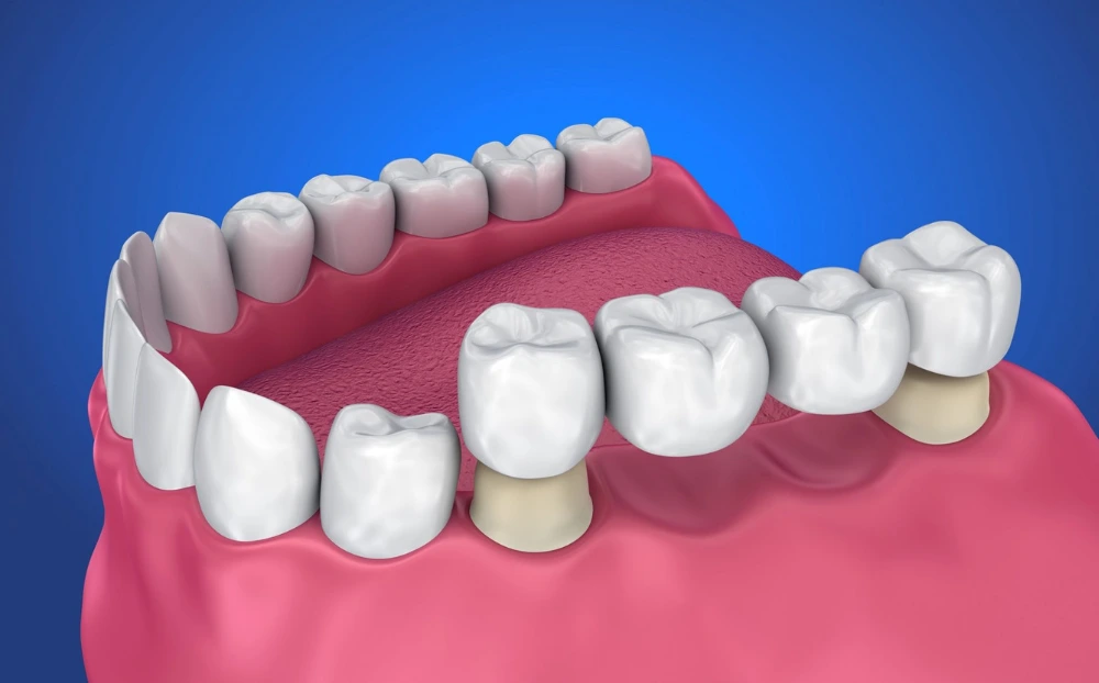 https://meditouring.com/wp-content/uploads/2025/11/teeth-bridge.webp