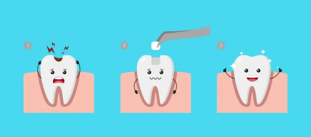 What Is a Composite Teeth Filling? Everything You Need to Know before vs after procedure
