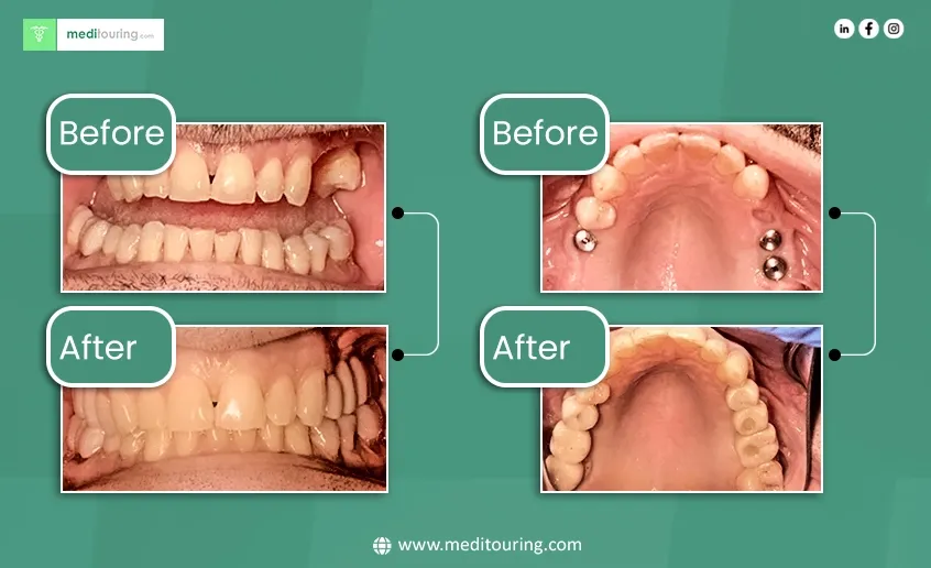 All on 6 Dental Implants in Italy: Complete Guide to Costs, Procedure & Results dental implant before after smile