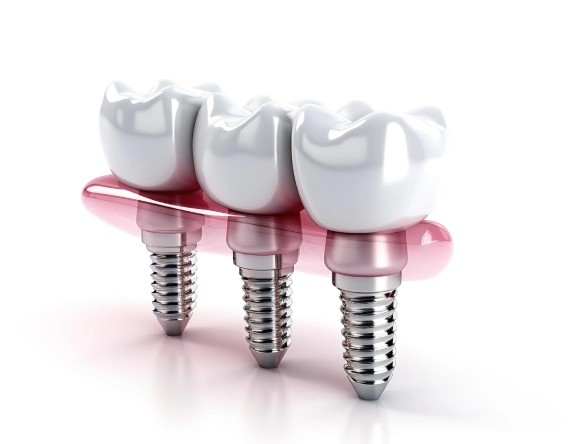 all on 4 dental implants (2)