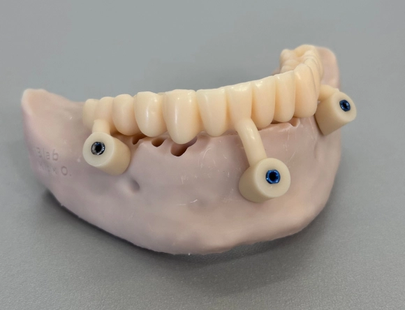 dental implants (3) dental implants (3)