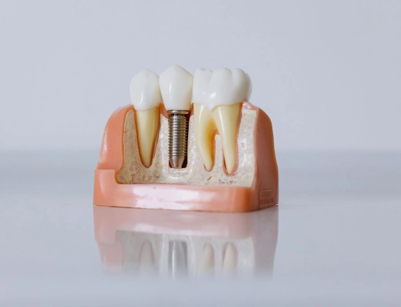 mouth restoration mouth restoration