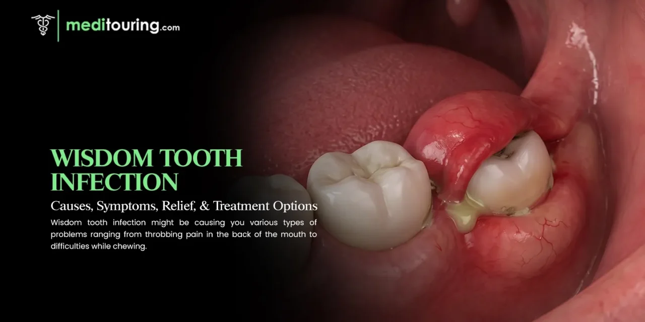 Wisdom Tooth Infection: Causes, Symptoms, Relief, and Treatment Options