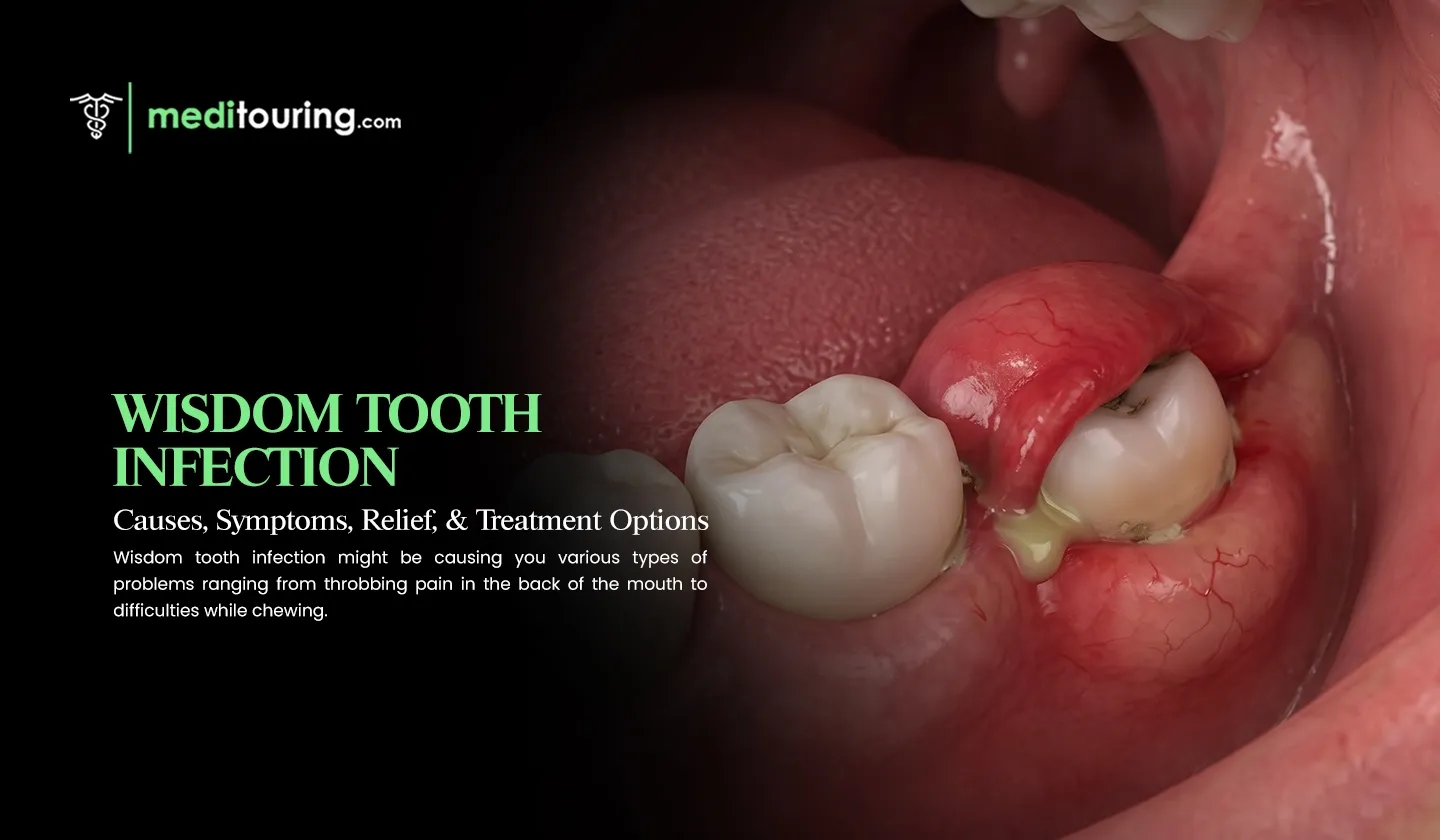 wisdom tooth infection